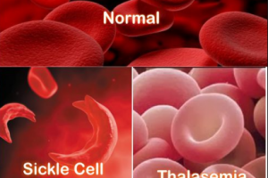 Penyebab Gangguan Peredaran Darah Pada Manusia - Berbagai Sebab