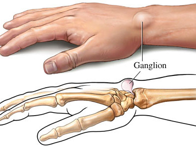 Punya Benjolan Di Pergelangan Tangan Atau Kaki Mungkin Itu Kista Ganglion