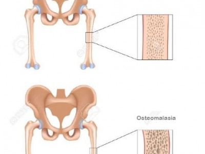 Kelainan Pada Sistem Gerak Manusia Kelainan Pada Sistem Gerak Manusia